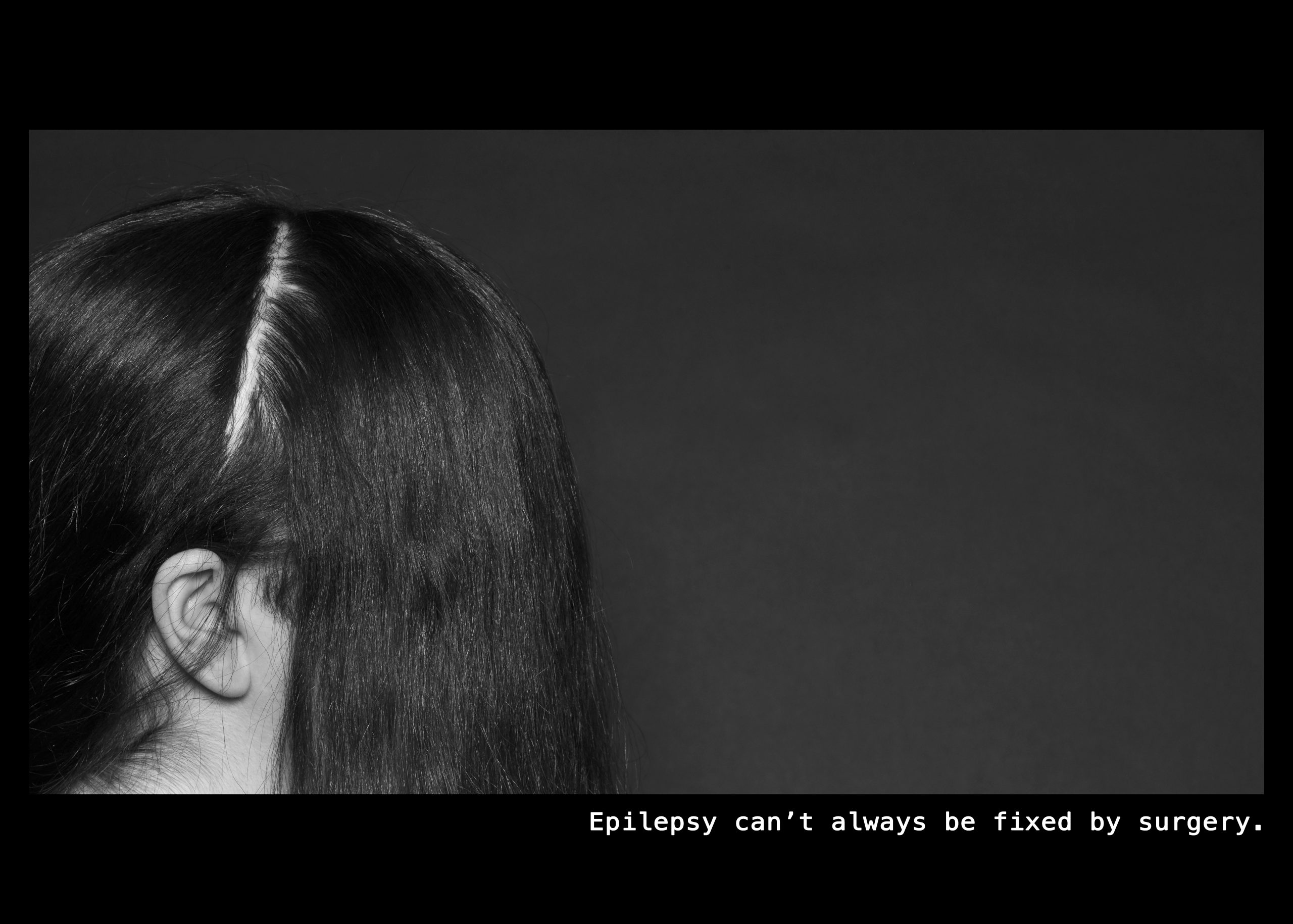 Image of a woman and the profile of her face. Her hair is parted exposing part of her skull. Text: Epilepsy can't always be fixed by surgery.